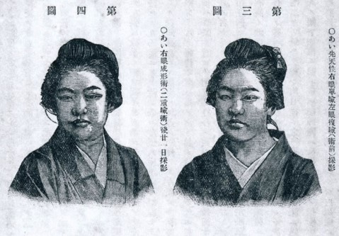 第3図右眼が術前 第4図右眼が術後21日目