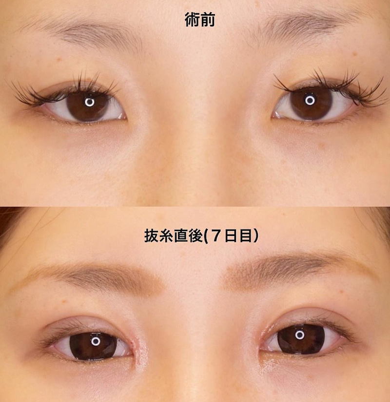 目について 東京都港区六本木のサフォクリニック