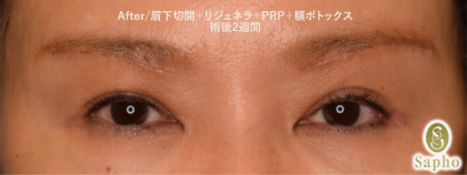 アフター2週間後