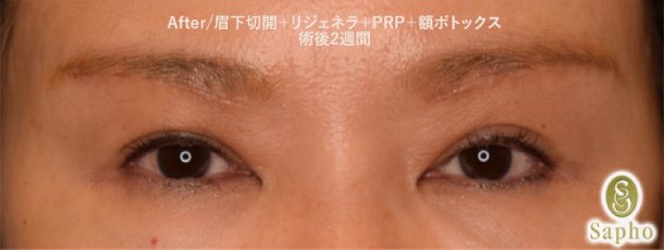 アフター2週間後