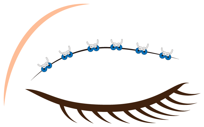 二重まぶた形成（白壁式ビーズ法）のイラスト