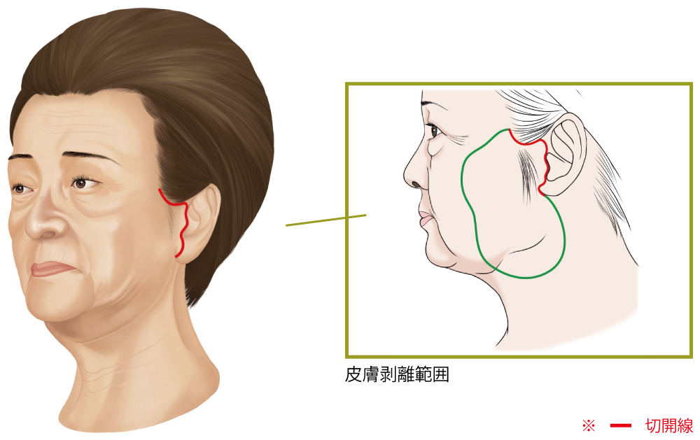 フェイスリフトの手術の仕方