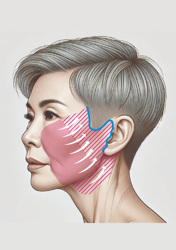 サフォオリジナル アングルフェイス&ネックリフト