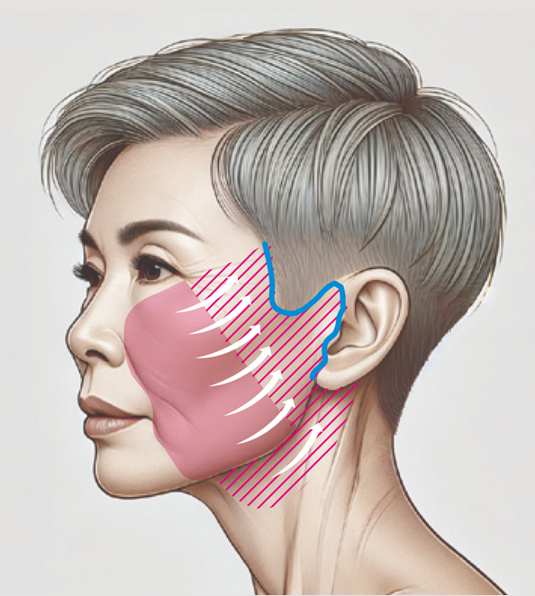 アングルフェイス＆ネックリフト