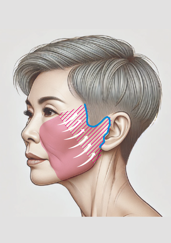 サフォオリジナル アングルフェイスリフト