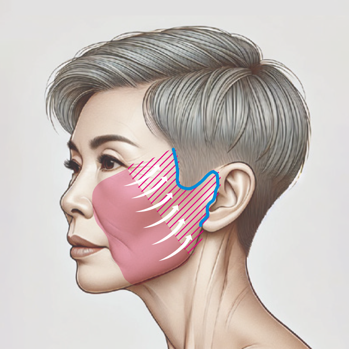 アングルフェイスリフト