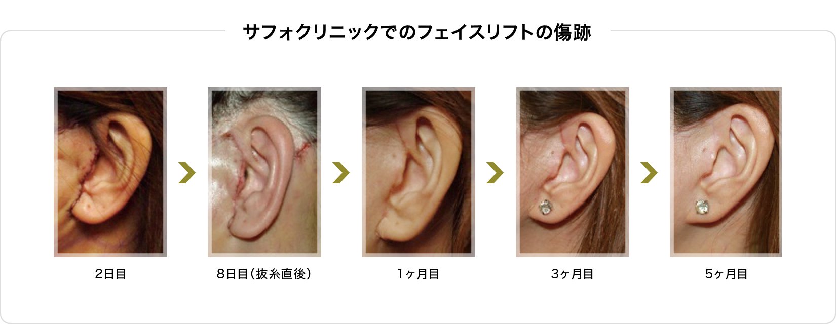 サフォでのフェイスリフトの傷跡