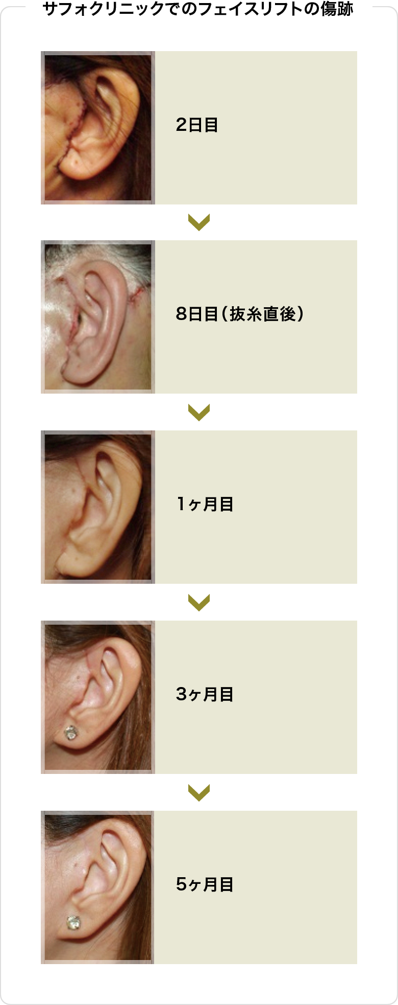 サフォでのフェイスリフトの傷跡