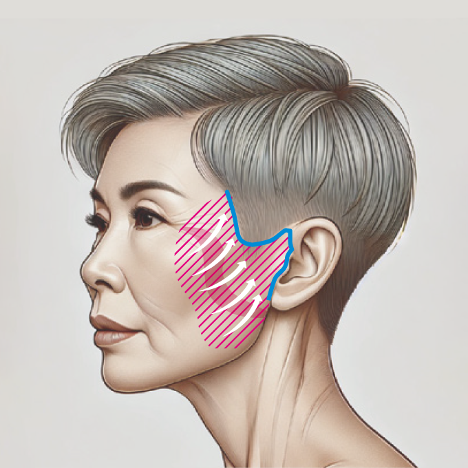 フェイスリフト