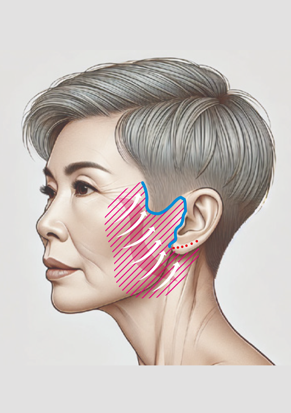 フェイスネックリフト