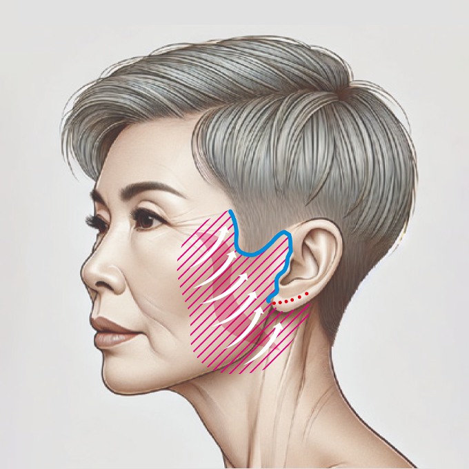 フェイスネックリフト