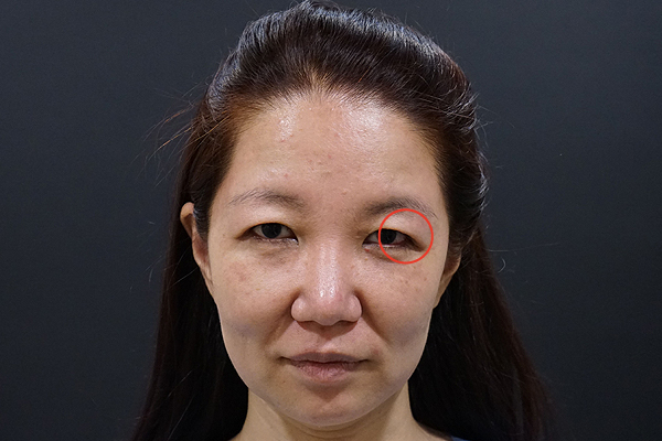 ネックフェイスリフトのモニター写真