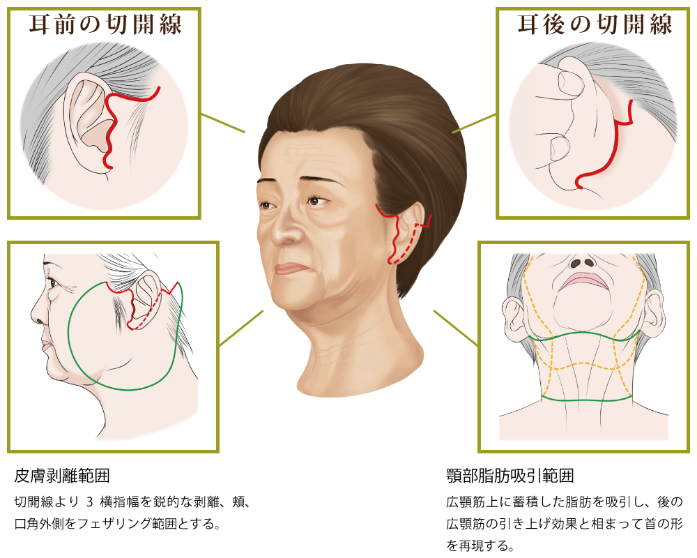 フェイスリフトの手術の仕方