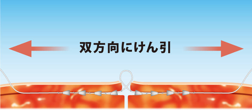 スレッドリフトの手術の仕方06