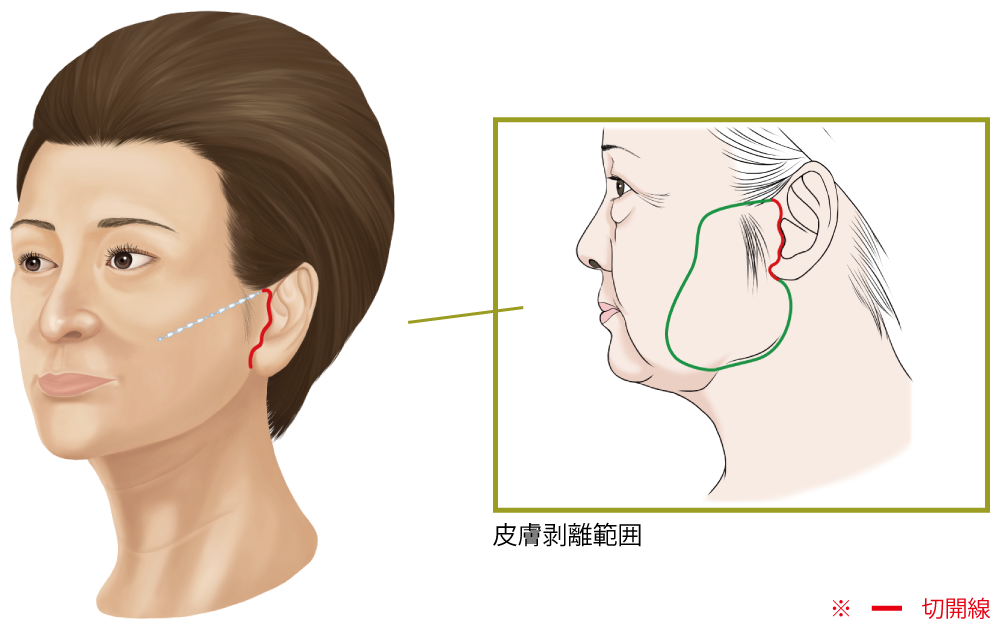 フェイスリフトの手術の仕方