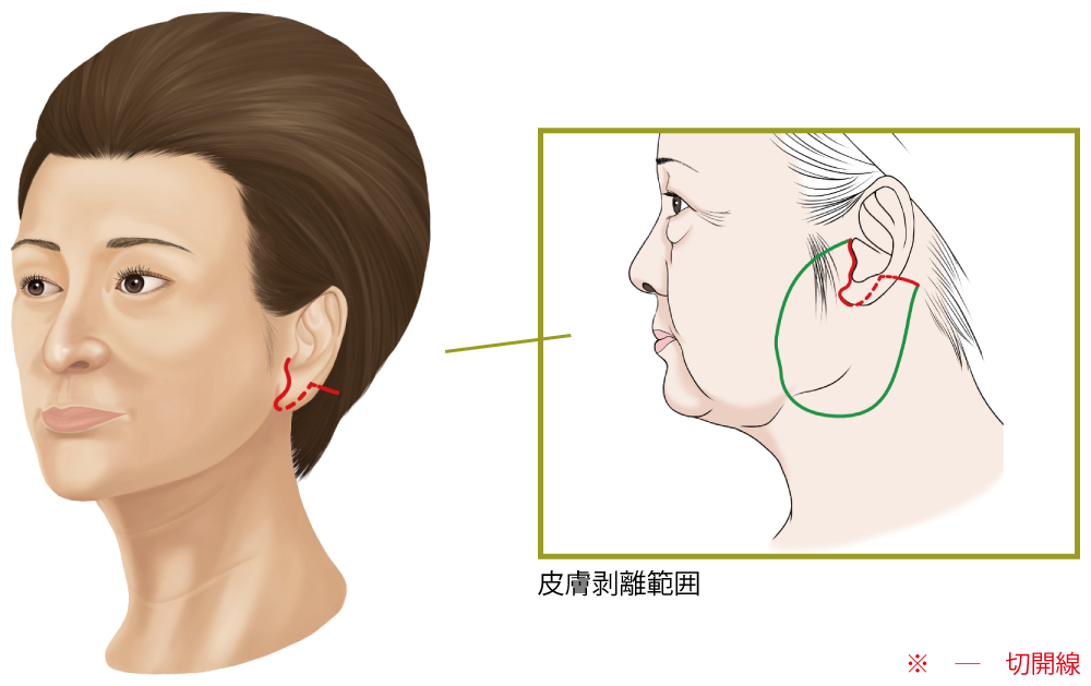 フェイスリフトの手術の仕方