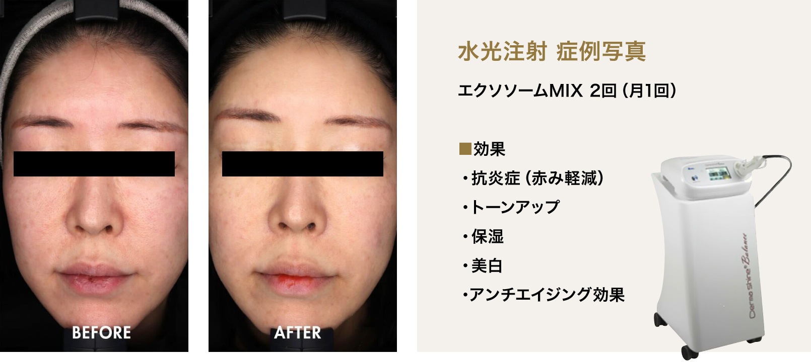 水光注射 症例写真 エクソソームMIX 2回(月1回)